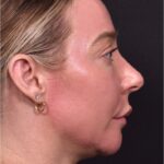 Atlanta chin implant revision natural scarless facial contouring balancing best before after female plastic surgery