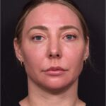 Atlanta chin implant revision natural scarless facial contouring balancing best before after female plastic surgery