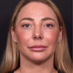 Atlanta chin implant revision natural scarless facial contouring balancing best before after female plastic surgery