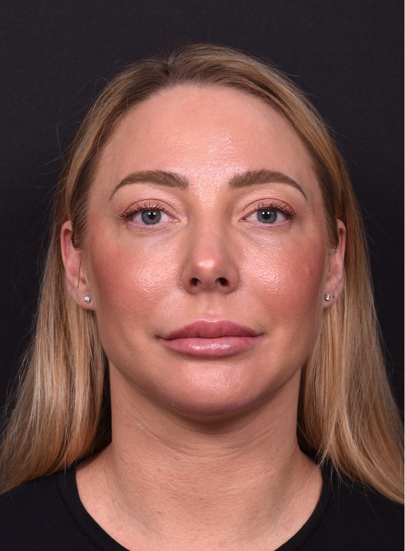 Atlanta chin implant revision natural scarless facial contouring balancing best before after female plastic surgery