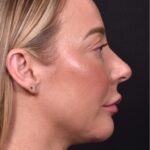 Atlanta chin implant revision natural scarless facial contouring balancing best before after female plastic surgery