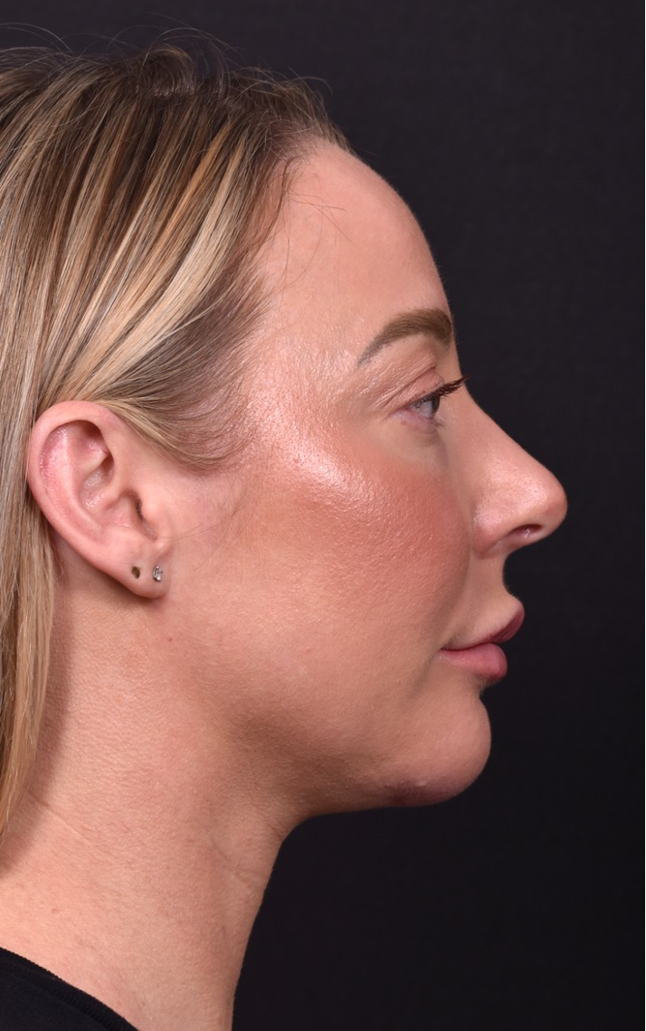 Atlanta chin implant revision natural scarless facial contouring balancing best before after female plastic surgery