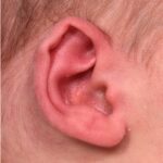 Earwell Atlanta baby ear correction nonsurgical results expert before after