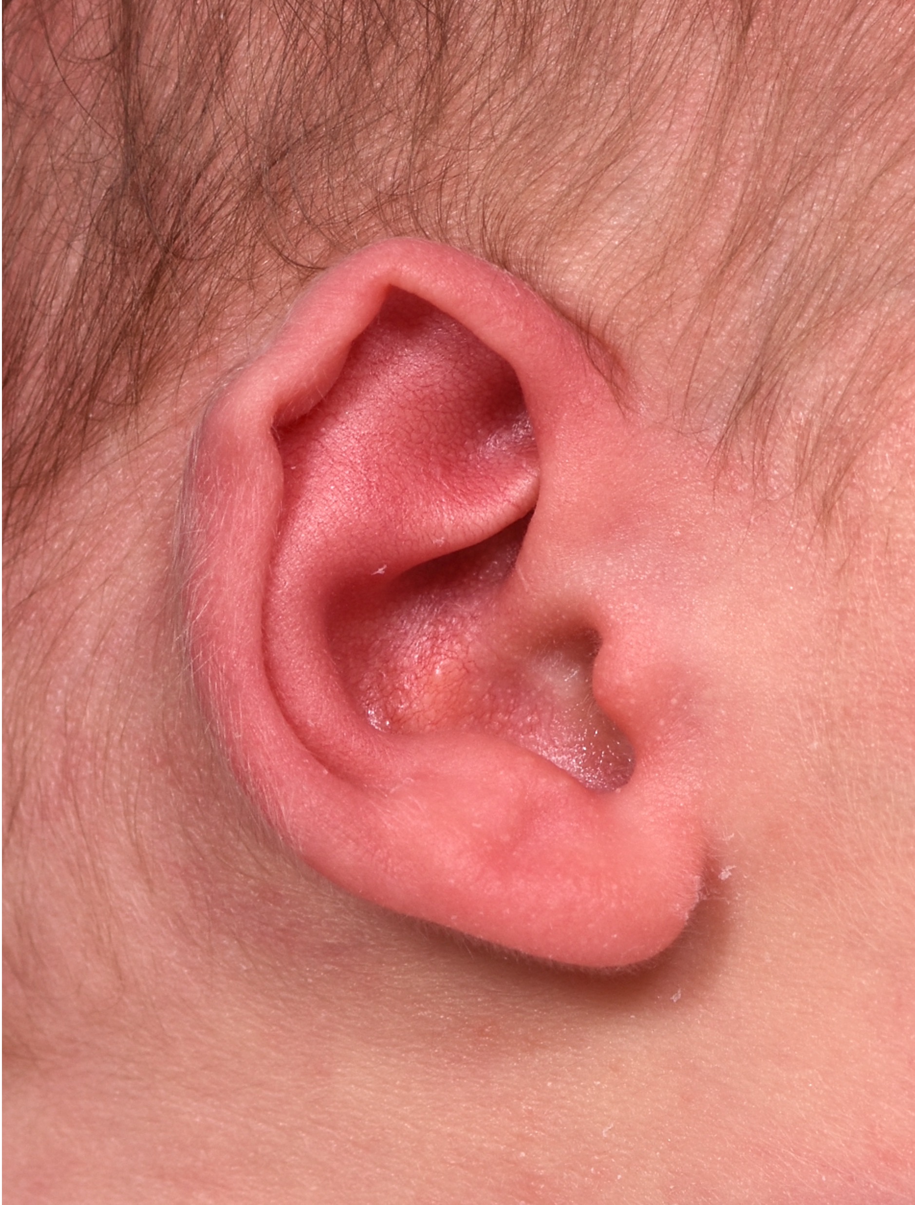 Earwell Atlanta baby ear correction nonsurgical results expert before after