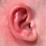 Earwell Atlanta baby ear correction nonsurgical results expert before after