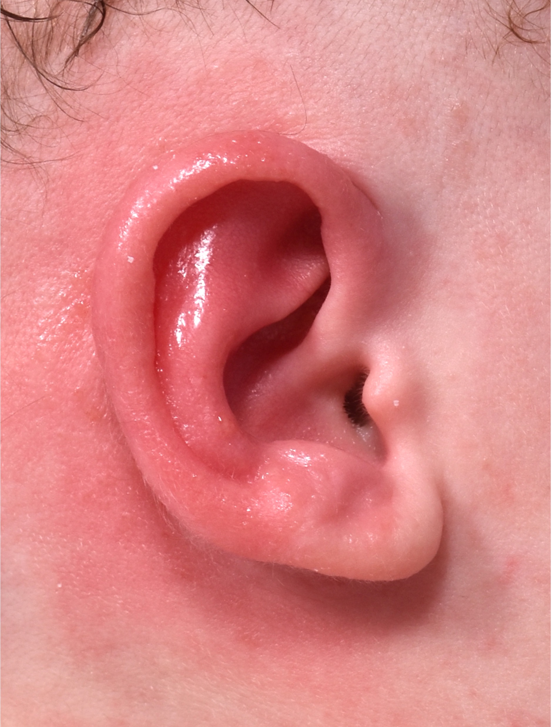 Earwell Atlanta baby ear correction nonsurgical results expert before after