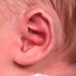 Earwell Atlanta baby ear correction nonsurgical results expert before after