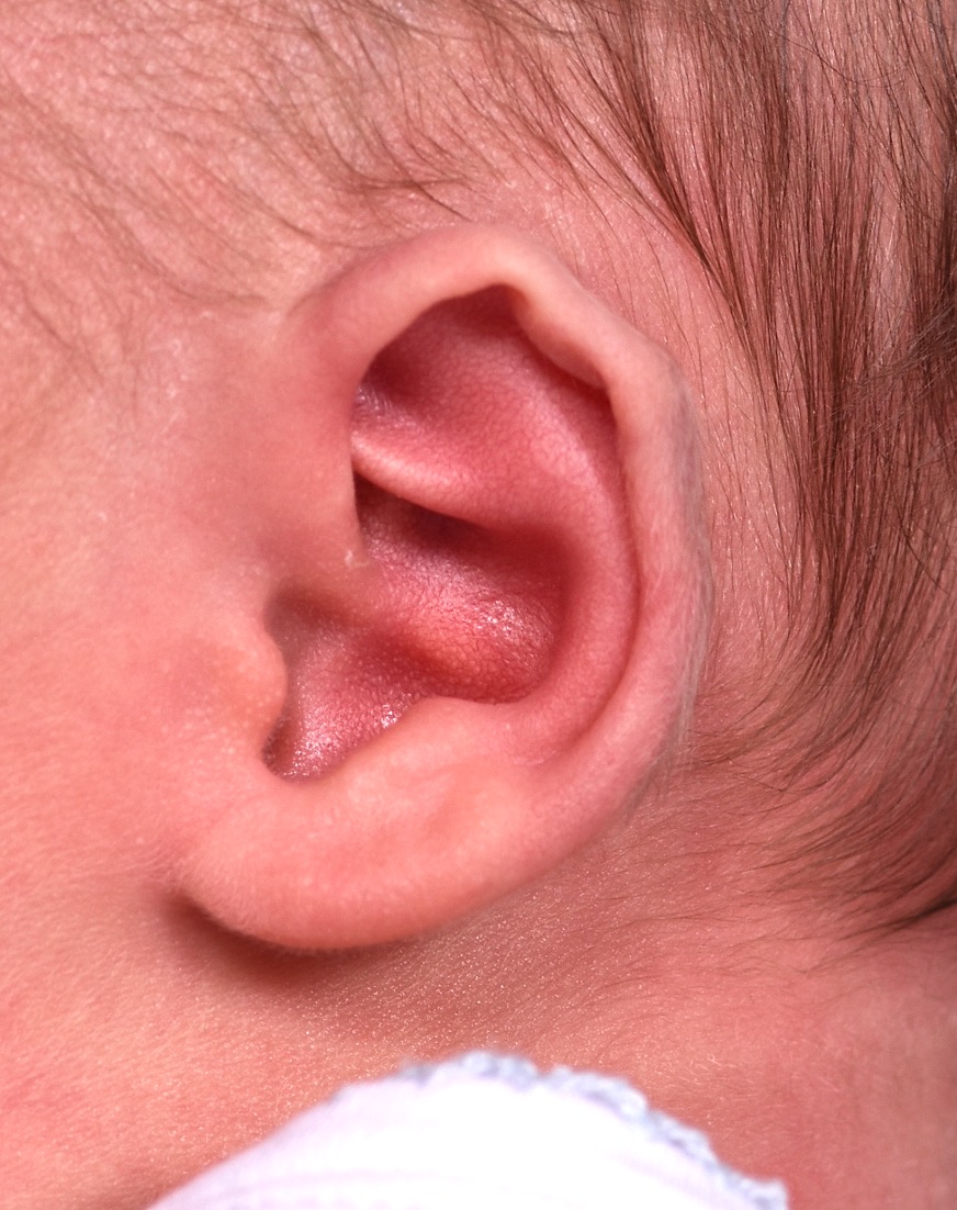 Earwell Atlanta baby ear correction nonsurgical results expert before after