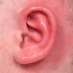 Earwell Atlanta baby ear correction nonsurgical results expert before after