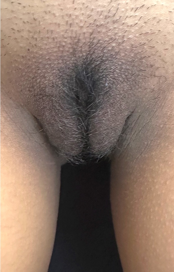 Atlanta labiaplasty results near me before after female plastic surgery cosmetic clit clitoral hood reduction before after