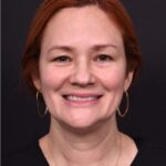 Atlanta deep plane face lift best expert near me female surgeon neck liplift