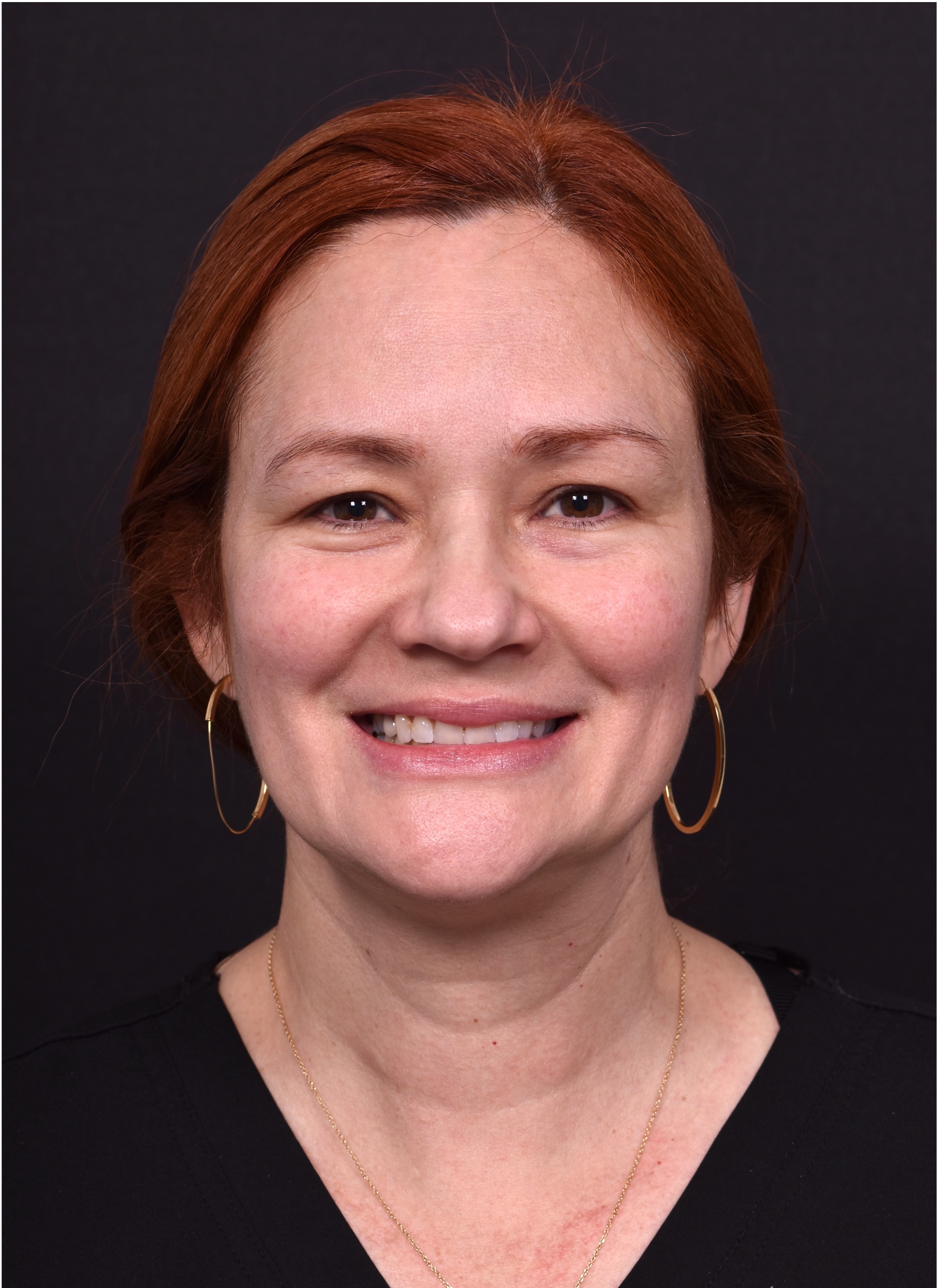 Atlanta deep plane face lift best expert near me female surgeon neck liplift