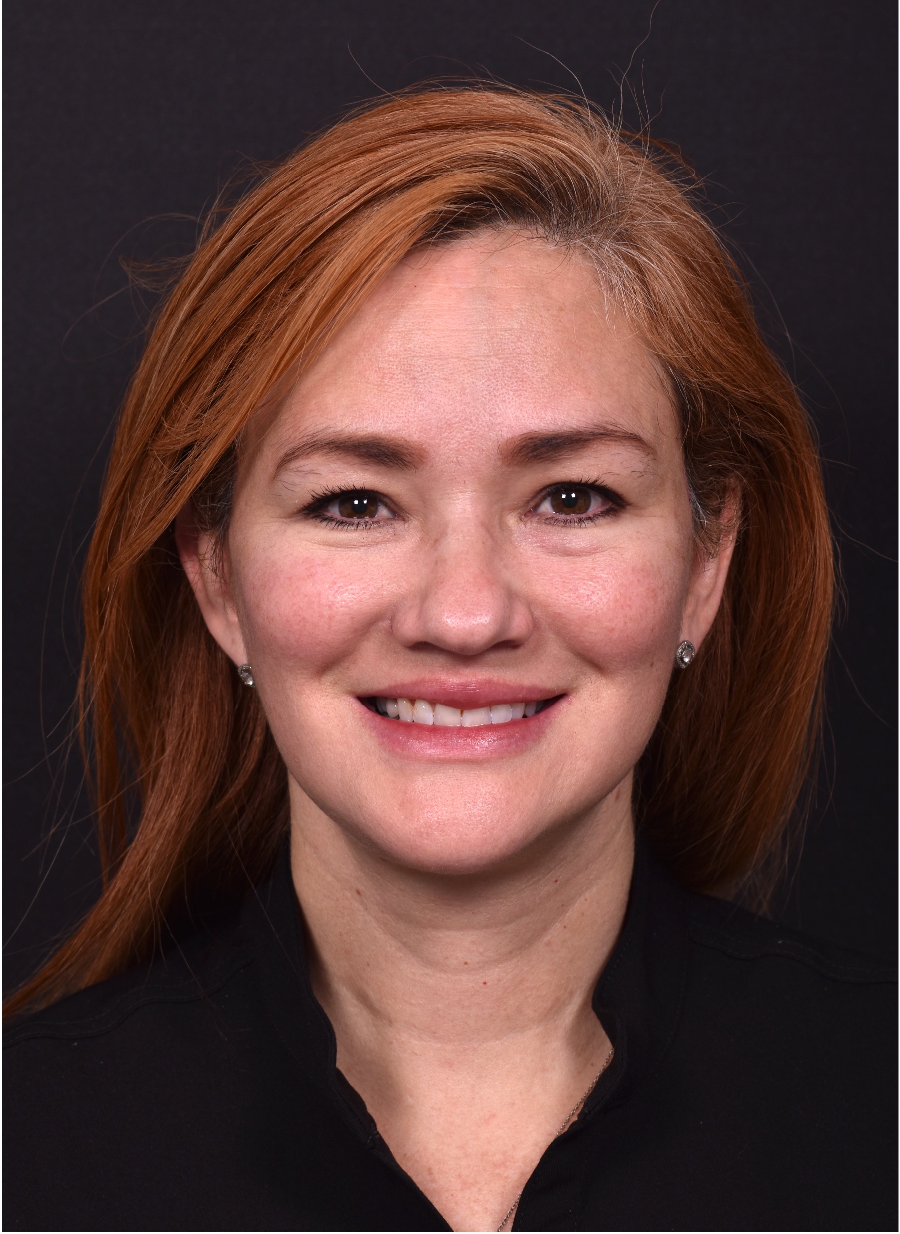 Atlanta deep plane face lift best expert near me female surgeon neck liplift