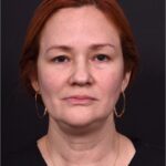 Atlanta deep plane face lift best expert near me female surgeon neck liplift