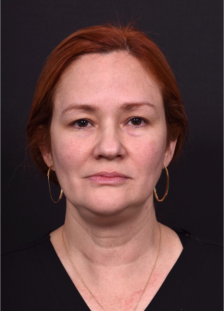 Atlanta deep plane face lift best expert near me female surgeon neck liplift