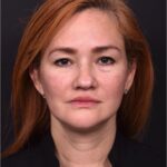 Atlanta deep plane face lift best expert near me female surgeon neck liplift