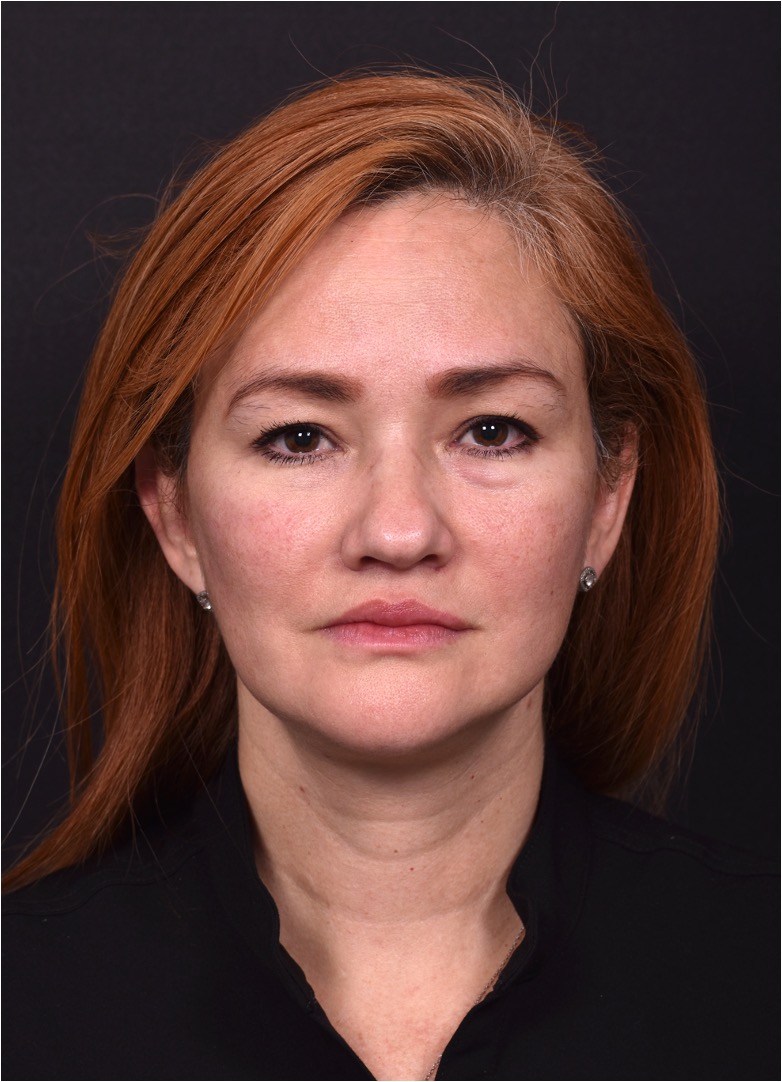 Atlanta deep plane face lift best expert near me female surgeon neck liplift