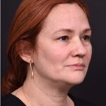 Atlanta deep plane face lift best expert near me female surgeon neck liplift