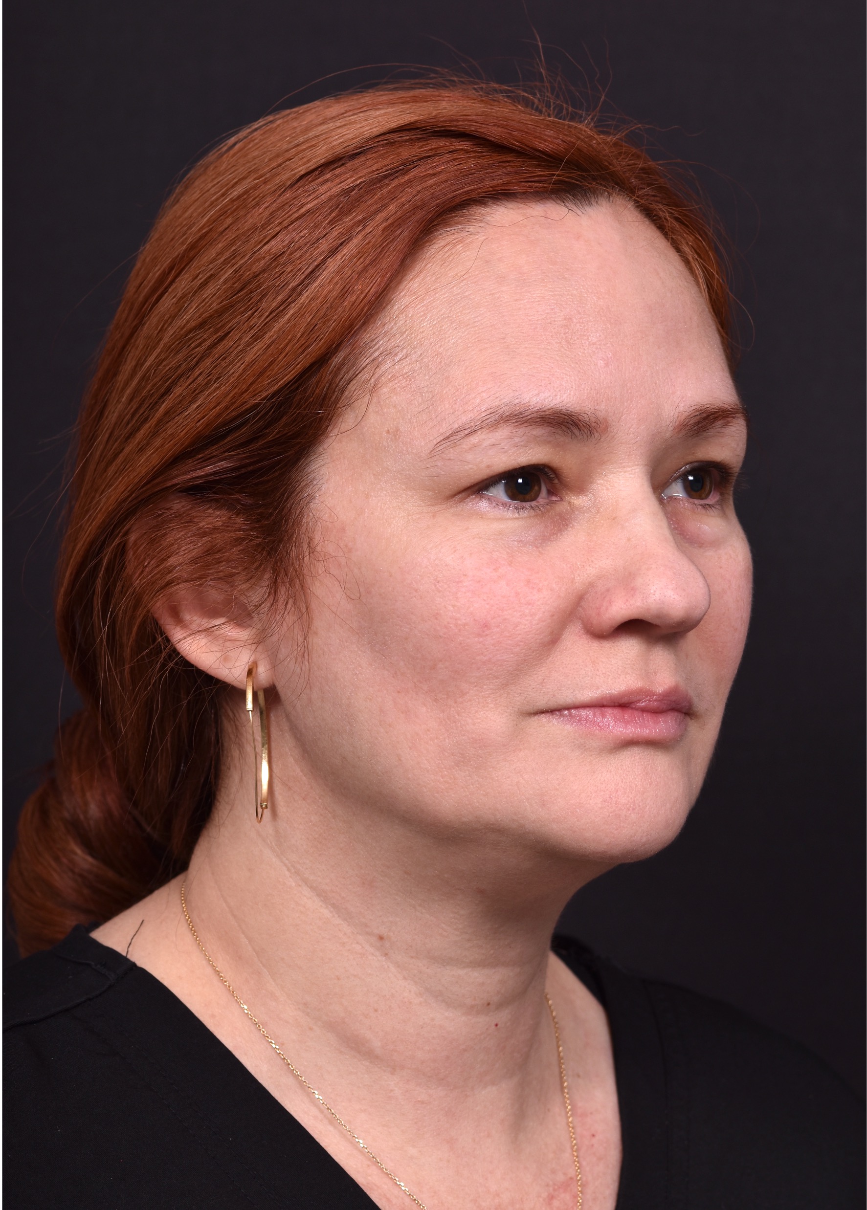 Atlanta deep plane face lift best expert near me female surgeon neck liplift