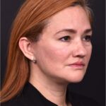 Atlanta deep plane face lift best expert near me female surgeon neck liplift