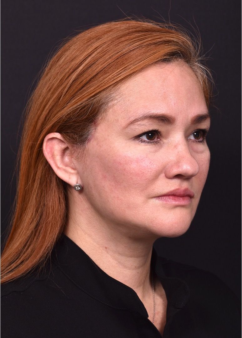 Atlanta deep plane face lift best expert near me female surgeon neck liplift