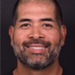 Forehead osteoma bump knot bone firm surgery treatment results best expert Atlanta before after