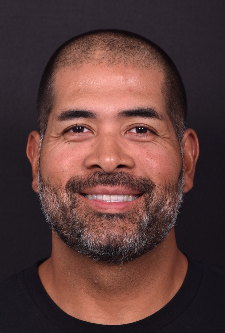 Forehead osteoma bump knot bone firm surgery treatment results best expert Atlanta before after