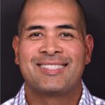 Forehead osteoma bump knot bone firm surgery treatment results best expert Atlanta before after