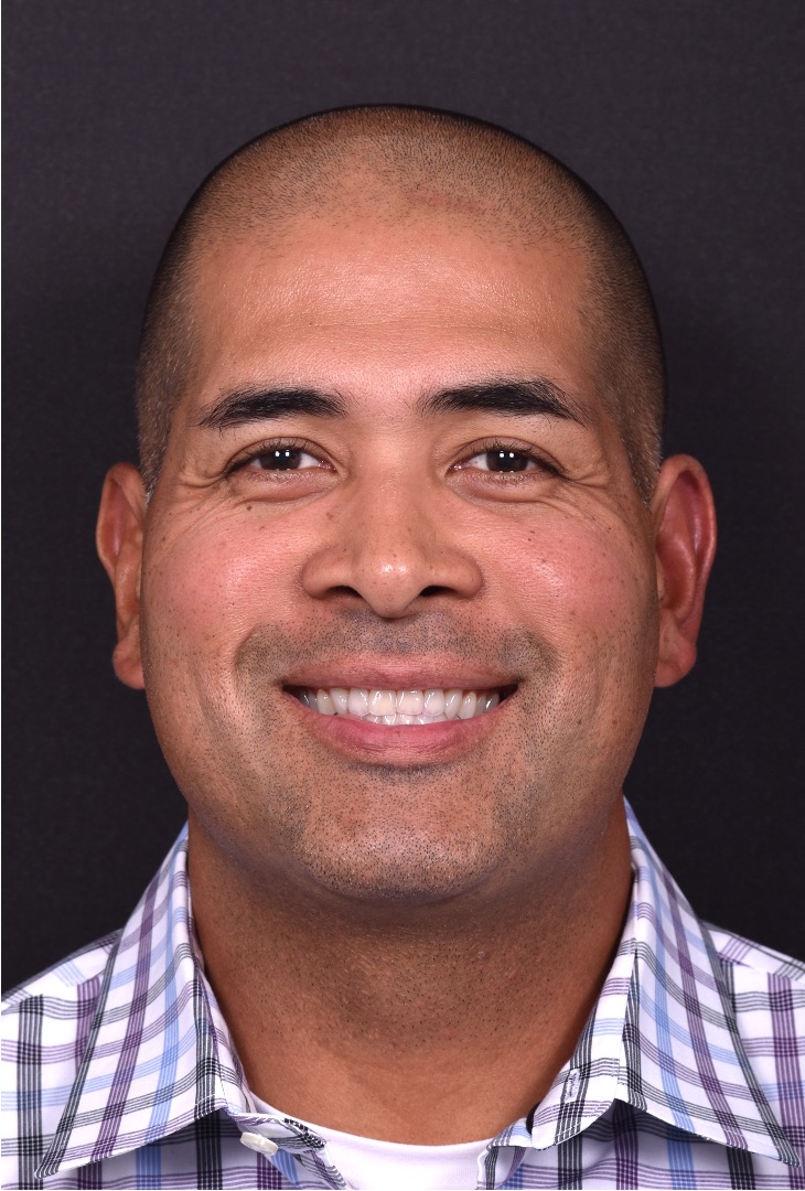 Forehead osteoma bump knot bone firm surgery treatment results best expert Atlanta before after