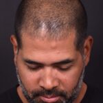 Forehead osteoma bump knot bone firm surgery treatment results best expert Atlanta before after