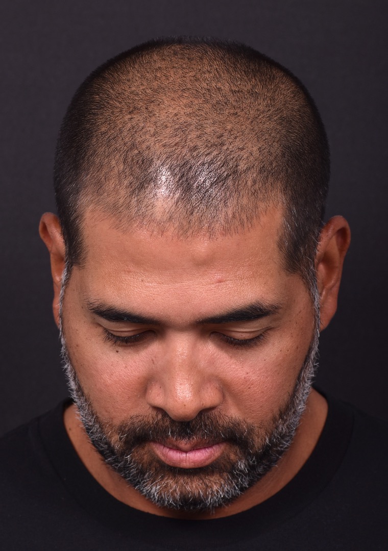 Forehead osteoma bump knot bone firm surgery treatment results best expert Atlanta before after