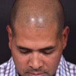 Forehead osteoma bump knot bone firm surgery treatment results best expert Atlanta before after