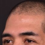 Forehead osteoma bump knot bone firm surgery treatment results best expert Atlanta before after