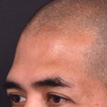 Forehead osteoma bump knot bone firm surgery treatment results best expert Atlanta before after