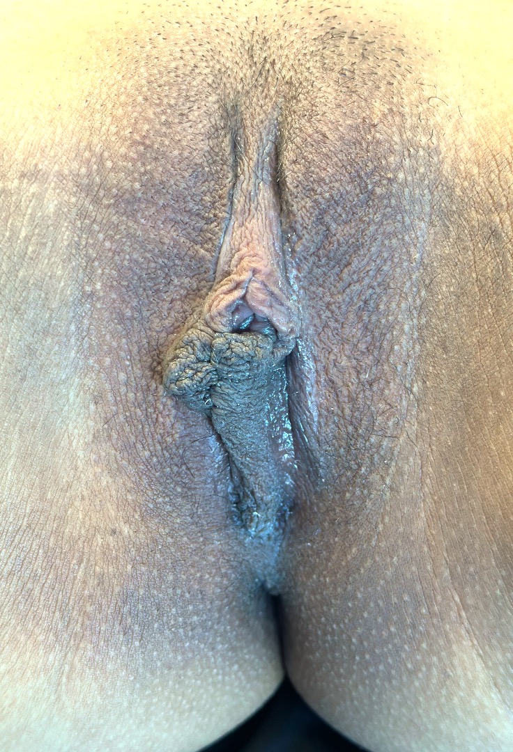 Atlanta labiaplasty near me best collagen results expert vagina clitoral hood reduction before after