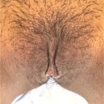 Atlanta labiaplasty near me best collagen results expert vagina clitoral hood reduction before after