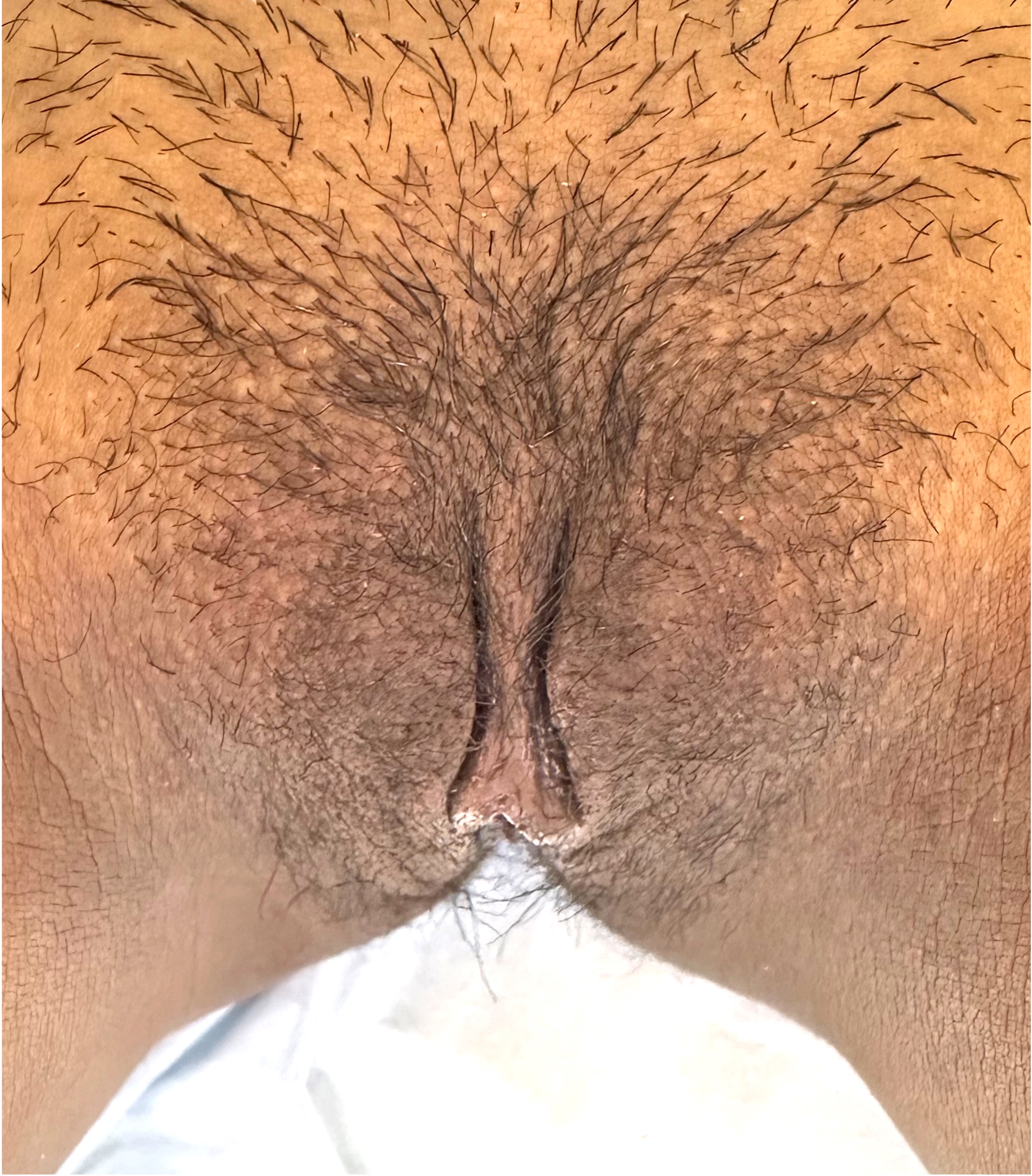 Atlanta labiaplasty near me best collagen results expert vagina clitoral hood reduction before after