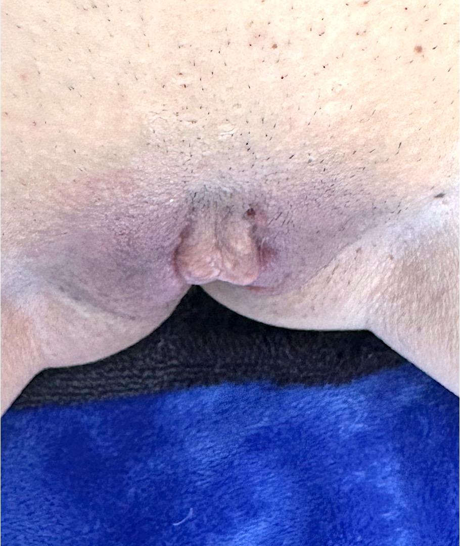 Atlanta labiaplasty near me before after results expert best female intimate vagina surgery