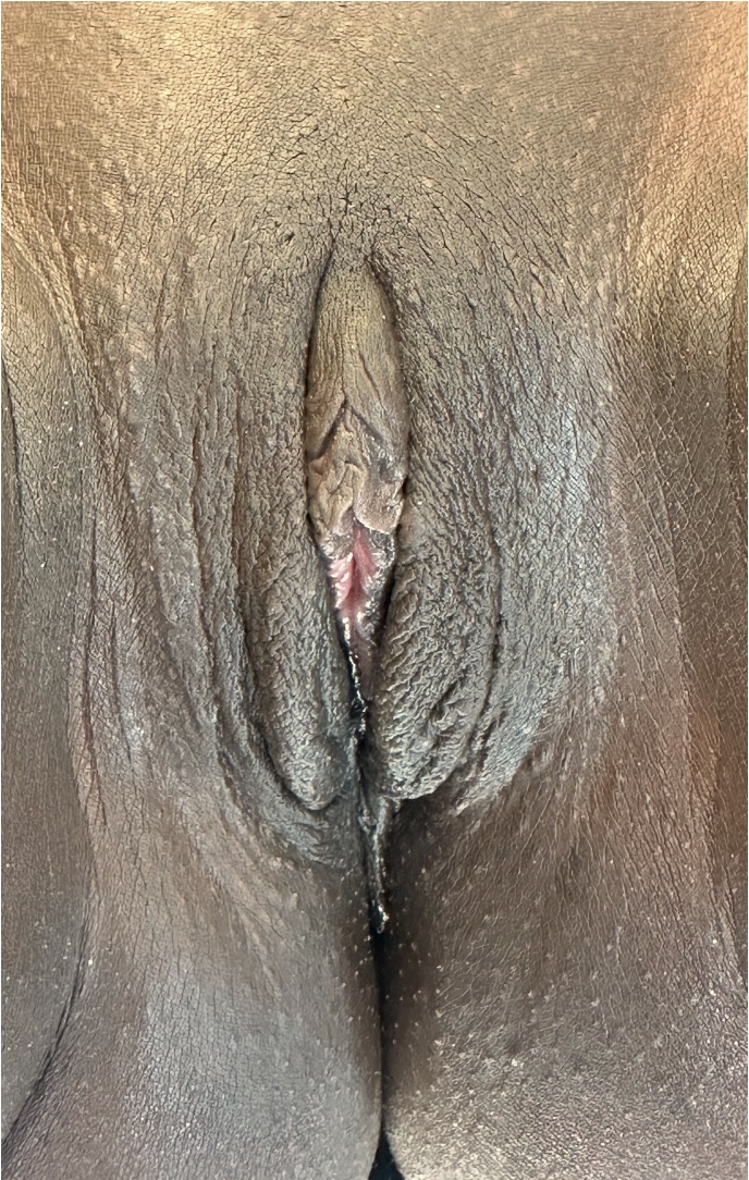 Atlanta labiaplasty before after expert best near me surgery vagina treatment tighten surgery