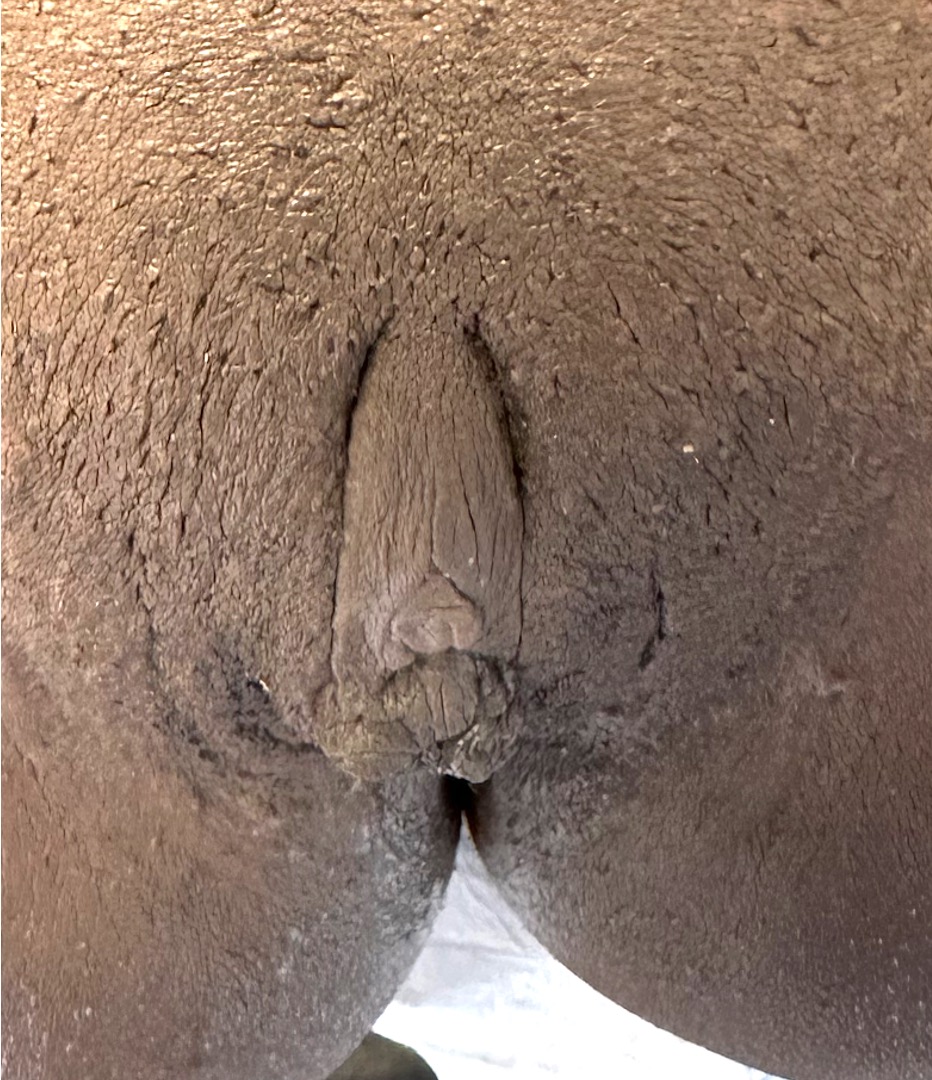 Atlanta labiaplasty before after expert best near me surgery vagina treatment tighten surgery