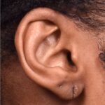 Atlanta earlobe repair stretched piercing gauged ear surgery otoplasty new me best