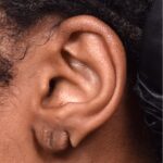 Atlanta earlobe repair stretched piercing gauged ear surgery otoplasty new me best