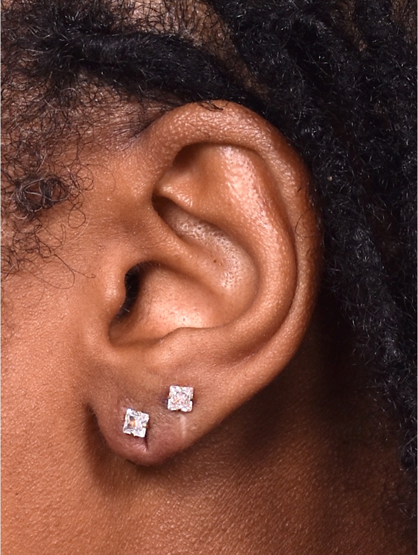 Atlanta earlobe repair stretched piercing gauged ear surgery otoplasty new me best