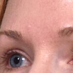 Atlanta Aviva mole clear birthmark treatment scarless before and after best near me expert