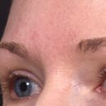 Atlanta Aviva mole clear birthmark treatment scarless before and after best near me expert