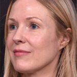 Atlanta Aviva mole clear birthmark treatment scarless before and after best near me expert