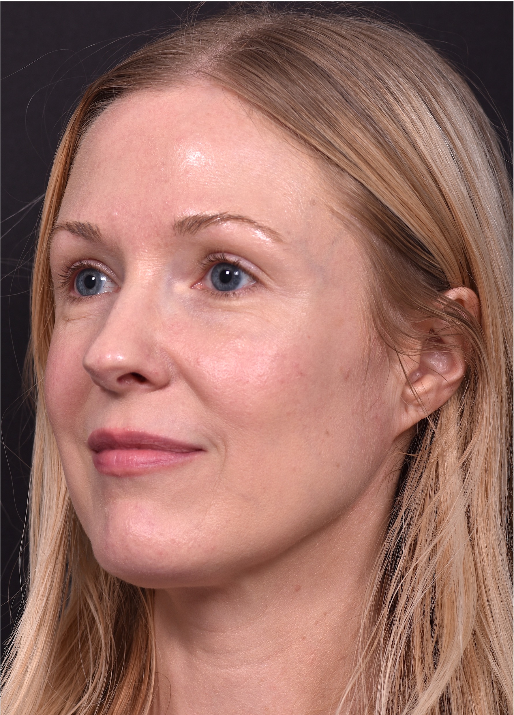 Atlanta Aviva mole clear birthmark treatment scarless before and after best near me expert