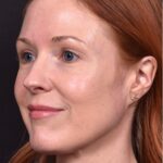 Atlanta Aviva mole clear birthmark treatment scarless before and after best near me expert