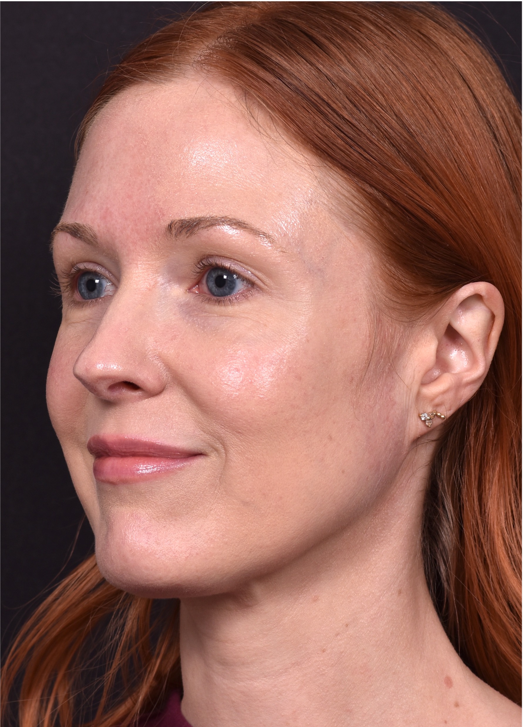 Atlanta Aviva mole clear birthmark treatment scarless before and after best near me expert