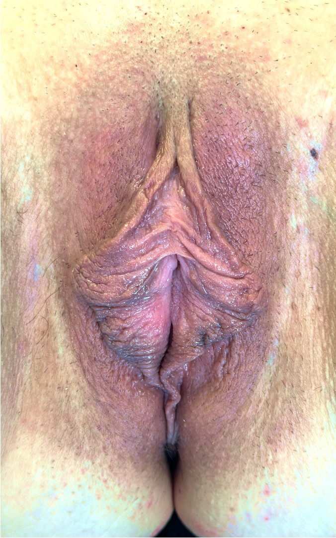 Aviva labiaplasty clitoral hood reduction perineoplasty Atlanta near me best expert female vagina collagen before and after